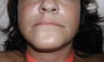 lip augmentation
