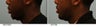 African American Lip Reduction