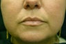 Restylane