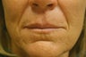 Restylane