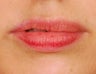 Restylane Lip Augmentation