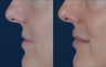 Lip Augmentation