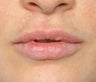 Lip Augmentation