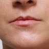 Non Surgical Lip Enhancement
