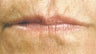 Facial Fillers- Lips