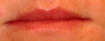 Facial Fillers- Lips
