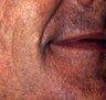 Facial Fillers Male