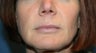 Lip augmentation