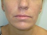 Lip Augmentation with Juvederm