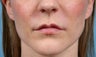 Lip Augmentation