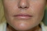 Perma Facial Implant