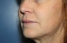 Lip augmentation