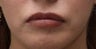 Lip Implant