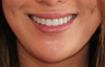 Lip Implant and Dimple Creation