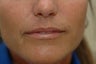 Perma Facial Implant