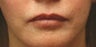 Lip Implant