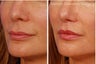Lip lift