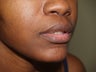 Upper Lip Lift