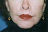 Direct Lip Lift