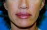 Upper and Lower Direct Lip Lift