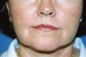 Corner of Lip Lift
