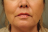 Upper lip shortening