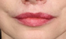 Lip lift