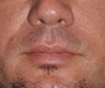 Lip Lift