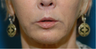 Lip lift + Chin implant + ArteFill