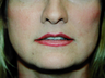 Sub Nasal Lip Lift