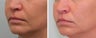 Bullhorn Lip Lift