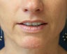 Lip lift