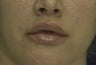Lip Lift
