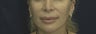Lip Lift
