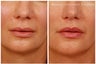 Lip lift