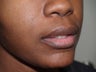 Upper Lip Lift