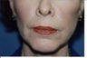 Direct Lip Lift