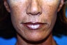 Upper and Lower Direct Lip Lift