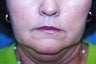 Corner of Lip Lift