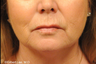 Upper lip shortening