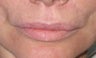 Lip lift