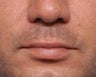 Lip Lift