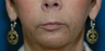 Lip lift + Chin implant + ArteFill
