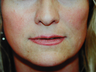 Sub Nasal Lip Lift