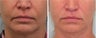 Bullhorn Lip Lift