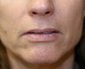 Lip lift