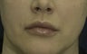 Lip Lift