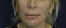 Lip Lift