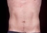 Liposuction