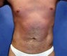 Liposculpture, Liposuction for men